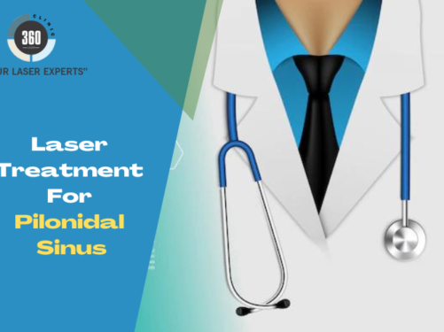 laser treatment for pilonidal sinus