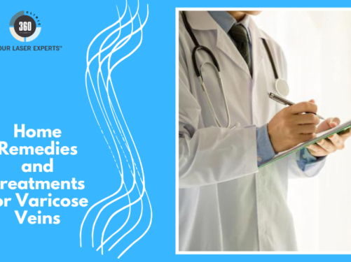 Laser treatment for varicose veins