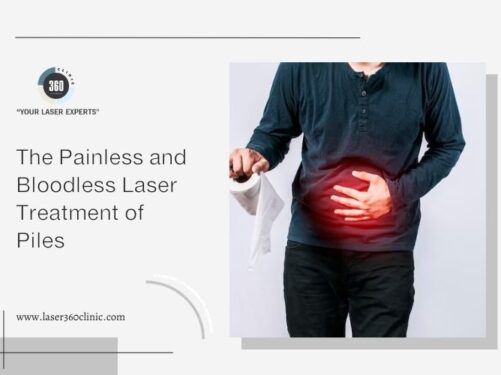 piles laser treatment cost