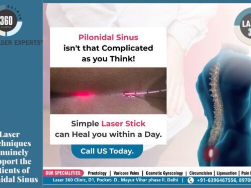 Laser Pilonidal Sinus Treatment in NCR