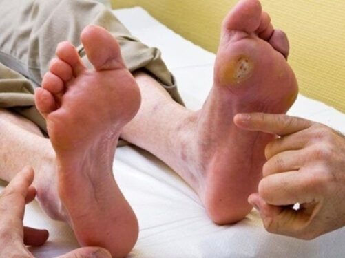 diabetic foot care